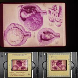 Utero. Miomatosis. (Alerac. Seund.)