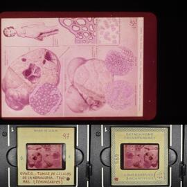 Ovario. Tumor de células de la graulosa. Tecomas (feminizantes)